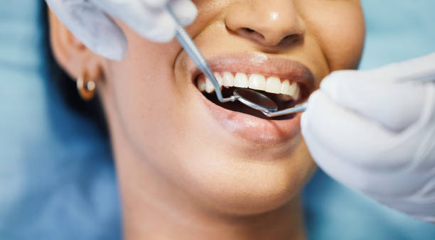 Best Emergency Wisdom Tooth Extraction in Woodstock, IL